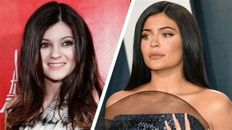 kylie jenner before and after|kylie jenner side by surgery.